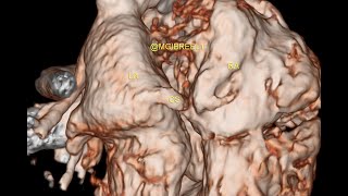 URCS Unroofed coronary sinus [upl. by Eisseb151]