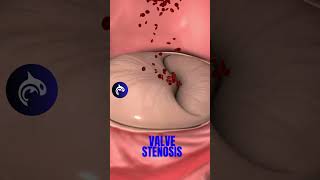 How you fix a Narrowed Heart Valve in 3D Animation valvuloplasty medicalanimation [upl. by Ynaffets]