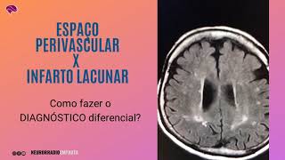 Espaço perivascular x infarto lacunar o DIAGNÓSTICO diferencial [upl. by Dviad]