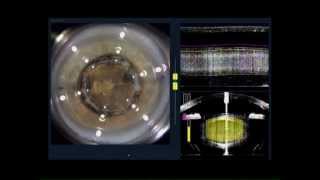 Femto laser Cataract surgery ReStor T LenSx Part 1 Laser treatment [upl. by Aoh]