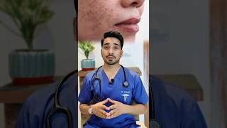 Best solution for Acne Marks pimple spots [upl. by Salba]