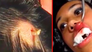 Huge Larva Pulled Out Of Ladys Scalp and Lip [upl. by Aliekat]