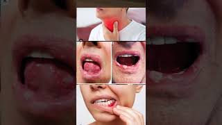 Betadine gargle use in hindi  betadine gargle  Povidone iodine gargle how to use viral shorts [upl. by Balch]