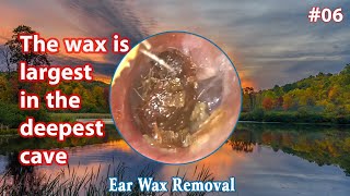 The gigantic stone entered the ears of ear​ 06earcleaning cleaning relaxing [upl. by Ariahaj]