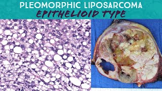 Pleomorphic liposarcoma epithelioid type Oregon Case 15 pathology sarcoma spindle cell neoplasm [upl. by Ajtak]