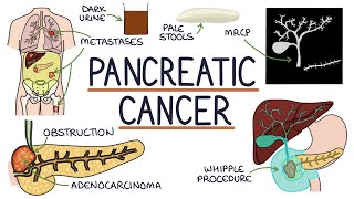 Understanding Pancreatic Cancer [upl. by Asiek]