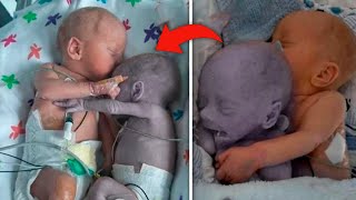 They placed a Healthy baby next to Dying Twin what happened Next is Heartbreaking [upl. by Melissa553]