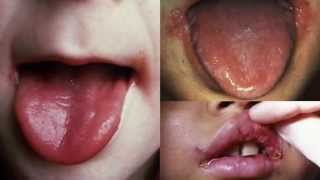 Angular Cheilitis Treatment  How to Get Rid of Angular Cheilitis in 24 hours [upl. by Enatan]