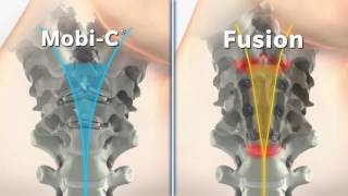 Mobi C vs Cervical Fusion Animation [upl. by Solly348]