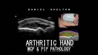 CS Arthritic Hand MCP amp PIP Pathology [upl. by Annayi993]