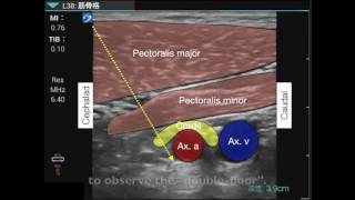 Brachial plexus infraclavicular approach [upl. by Ellehsad]