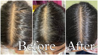 My Honest Hair loss Journey amp How I fixed it [upl. by Lerual]