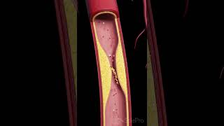 Atherosclerosis The Silent Build UpFollowAtherosclerosis occurs when fatty deposits [upl. by Fabiolas]