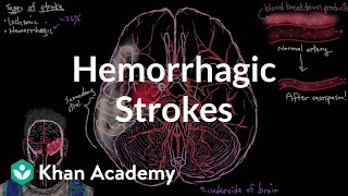 Hemorrhagic strokes  Circulatory System and Disease  NCLEXRN  Khan Academy [upl. by Loresz]