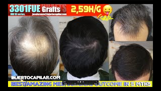 3301Grafts NW IIIvertex Bestamazing medsurgical outcome in 5 monthsInjertocapilarcom29692023 [upl. by Chavey652]