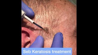 Seborrheic Keratosis Age Spots Removal with Radiosurgery  London Skin Clinics [upl. by Eadmund501]