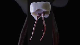 Every root canal is unique Cleaning and scaling teeth amp tartar amp calculus teethcare smileteethcare [upl. by Winnick811]