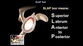 SLAP Tear  Everything You Need To Know  Dr Nabil Ebraheim [upl. by Kilar]