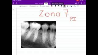 LO QUE SE VE EN UNA RADIOGRAFÍA DENTAL Zona 7 de premolares inferiores [upl. by Ocko]