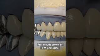 Dental crown fullmouthrehabilitation dentalcrown dentalcap [upl. by Penland]