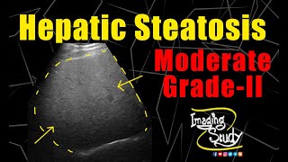 Moderate Hepatic Steatosis  Moderate Fatty Infiltration  Ultrasound  Case 171 [upl. by Marius]