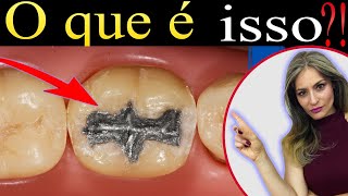 Você não sabe o que é Obturação de Dente TENHO CERTEZA [upl. by Issim]