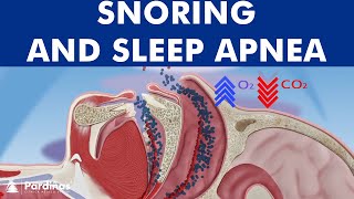 Snoring and sleep apnea  How to treat it © [upl. by Selena411]