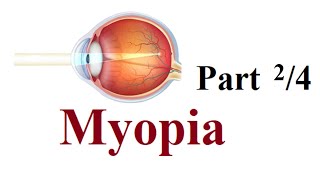 myopia  pathology and risk factors Part 24 [upl. by Ettenil]