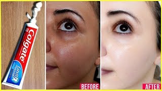 Apply Toothpaste on Your Skin and See Magical Result within 1 Hour ¦Amazing Toothpaste Beauty Hacks [upl. by Akiwak]