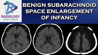 Benign Subarachnoid Space enlargement of infancy [upl. by Nomal186]