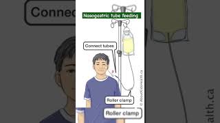 Nasogastric tube feeding  Ryles tube mbbs neet motivation aiims medical hospital [upl. by Gualterio520]