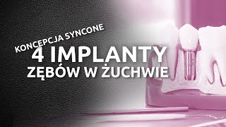 4 implanty zębów w żuchwie  koncepcja SynCone dla protezy overdenture na 4 implantach Ankylos [upl. by Chaddy]