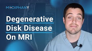 Degenerative Changes of the Lumbar Spine on MRI [upl. by Eleazar]