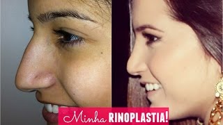 Minha rinoplastia cirurgia no nariz [upl. by Thurlow]