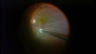 Vitrectomy for Retinal Detachment  Macula is Detached [upl. by Coretta]