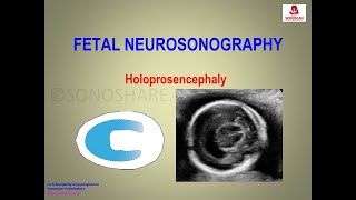 Fetal Neurosonography – Holoprosencephaly [upl. by Eidnar]