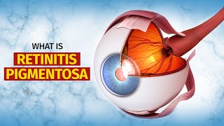 What is Retinitis Pigmentosa RP  Symptoms Treatment and More [upl. by Yemac790]