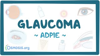 Glaucoma Nursing Process [upl. by Cris]