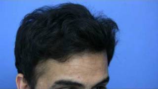 Hair Transplant by Dr Hasson  4200 Grafts  1 Session [upl. by Idnac]