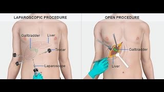 What are Gallstones Causes Symptoms  Treatment of Gallstone [upl. by Bostow]