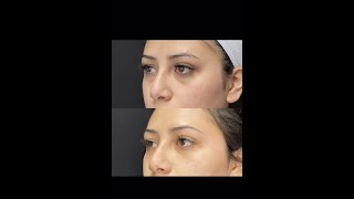 Under Eye Filler Treatment with PA Cathy  Ageless MD [upl. by Lawton]