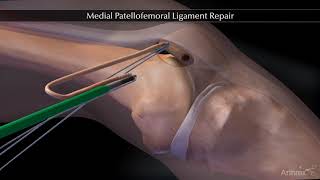 Medial Patellofemoral Ligament Repair [upl. by God517]