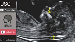 Fetal Nuchal translucency amp Nuchal fold ultrasound by DrFatima [upl. by Schroeder]