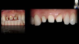 Restoration of endodontically treated teeth No post  No Ferrule  No Crown By Pascal Magne [upl. by Inirt]