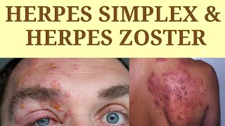 Herpes Simplex  Herpes Zoster skin skininfection herpesvirus herpeszoster herpessimplex [upl. by Darcy]