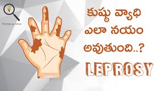 LEPROSY  కుష్ఠు వ్యాధి  LEPROSY IN TELUGU [upl. by Ahsyle211]