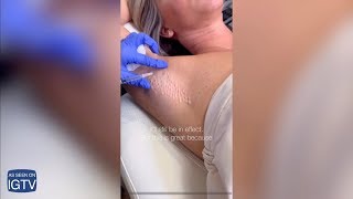 Botox for Sweaty Armpits [upl. by Macfarlane]