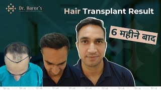 Best Hair Transplant in Delhi  Hair Transformation in 6 Months [upl. by Aihcropal842]