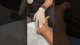 Cortisone Injection for Heel Pain Plantar Fasciitis [upl. by Thorin]