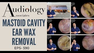 MASTOID CAVITY EAR WAX REMOVAL  EP590 [upl. by Alliuqat]